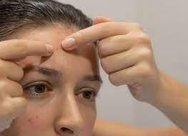 how to get rid of acne on forehead